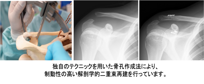 肩鎖関節