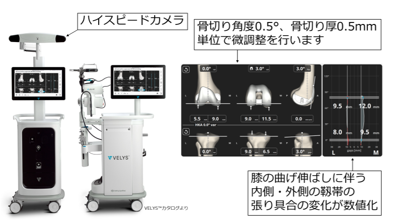 TKA1