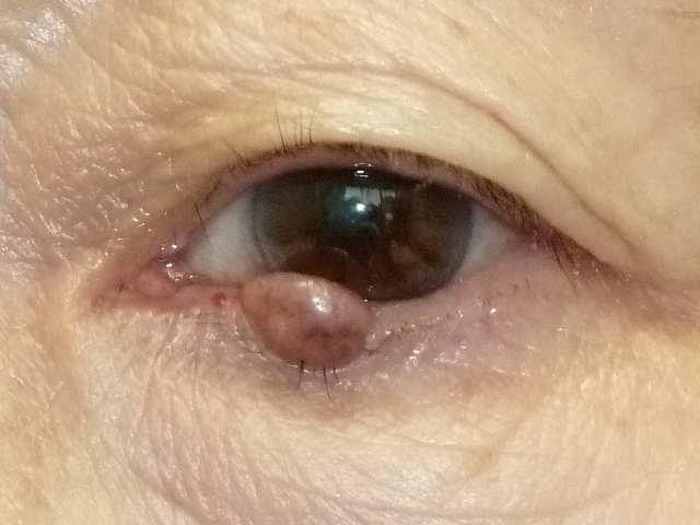 眼瞼の腫瘍
