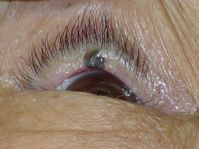眼瞼の腫瘍
