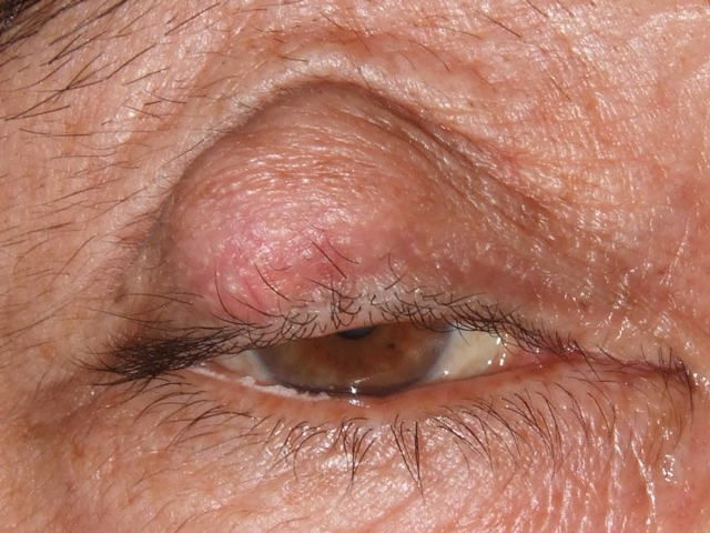 でき した もの まぶた 目やまぶたの「腫れ」症状と考えられる病気