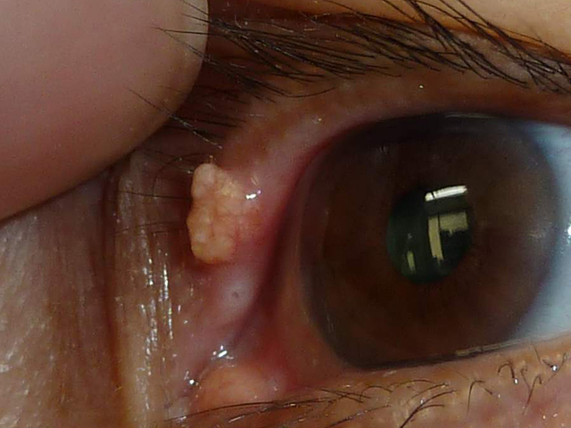 白い まぶた 出来 裏 物 の 眼瞼の腫瘍