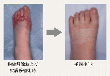 足背熱傷瘢痕拘縮の画像