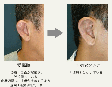 耳介血腫の画像
