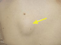 脂肪腫の画像