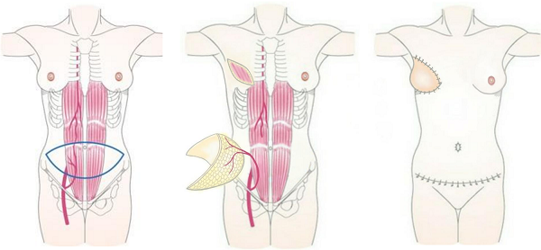 ➀腹部皮弁による乳房再建の画像