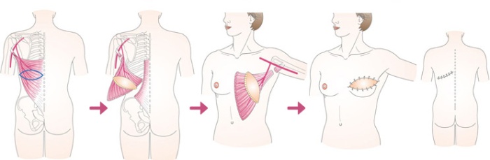 ➁広背筋皮弁による乳房再建の画像