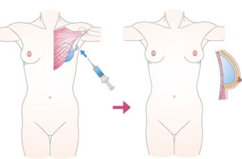 人工乳房による再建の画像
