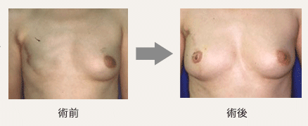 乳房再建の画像