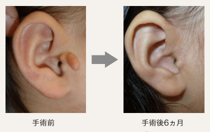 副耳の画像