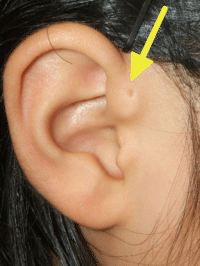 耳前瘻孔、耳瘻孔の画像1