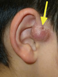 耳前瘻孔、耳瘻孔の画像3