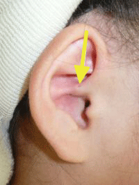 耳前瘻孔、耳瘻孔の画像2