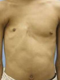 大胸筋欠損の典型例の画像