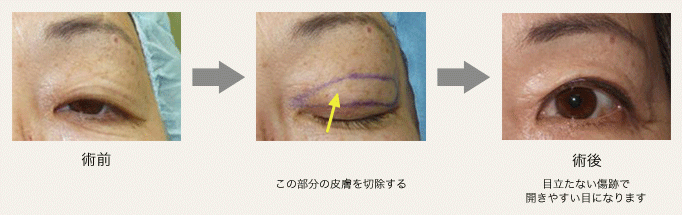 眼瞼余剰皮膚切除術の画像
