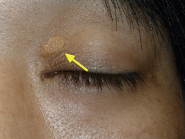 眼瞼黄色腫の画像