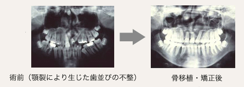 顎裂の治療例の画像