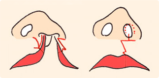 口唇形成術の画像