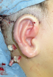 耳介挙上術の画像