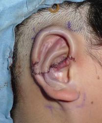 耳甲介型小耳症の画像