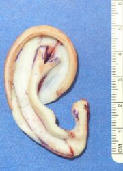生え際の低い小耳症の画像