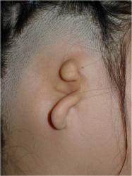 耳垂型小耳症の画像