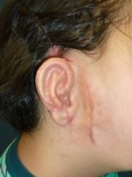 生え際の低い小耳症の画像