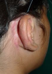 耳介挙上術の画像